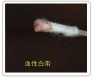 白帶帶有血絲怎么回事
